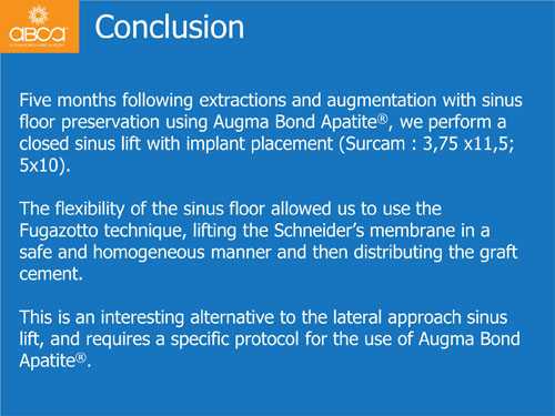 Closed Sinus Lift with Augma Bond Apetite