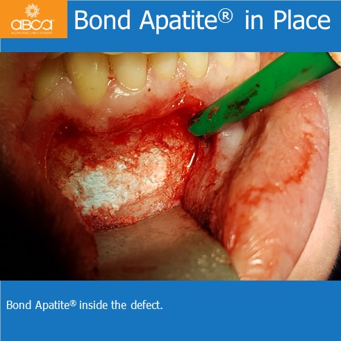 Osteoid Osteoma in the Front of the Mandible