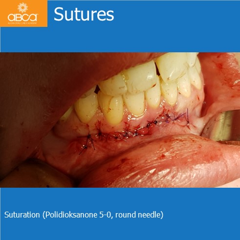 Osteoid Osteoma in the Front of the Mandible