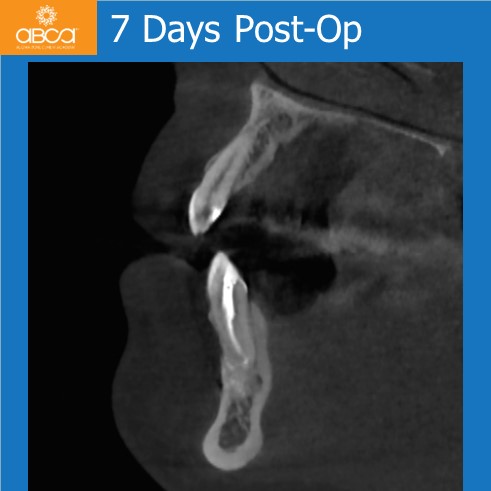 Osteoid Osteoma in the Front of the Mandible