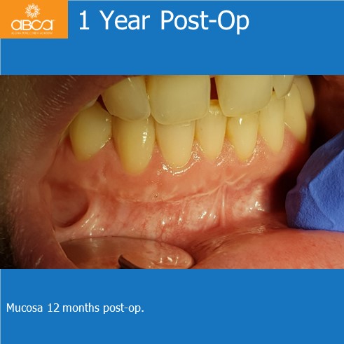 Osteoid Osteoma in the Front of the Mandible