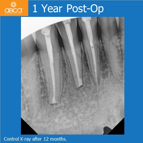 Osteoid Osteoma in the Front of the Mandible