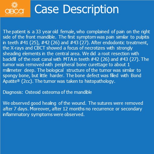Osteoid Osteoma in the Front of the Mandible