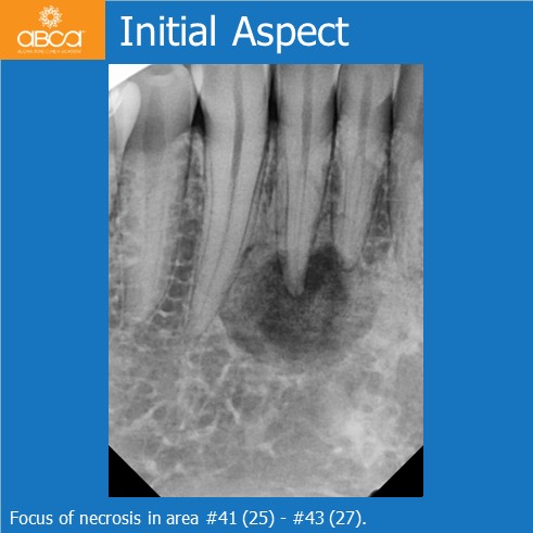 Osteoid Osteoma in the Front of the Mandible