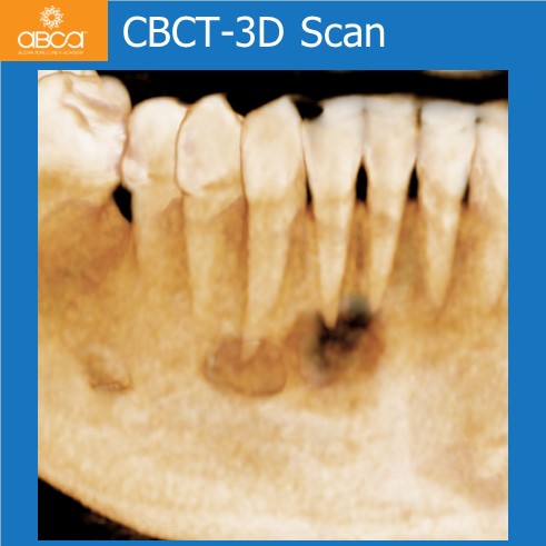 Osteoid Osteoma in the Front of the Mandible