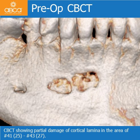 Osteoid Osteoma in the Front of the Mandible