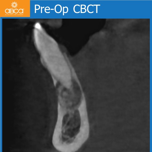 Osteoid Osteoma in the Front of the Mandible