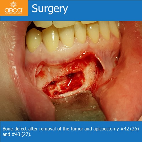 Osteoid Osteoma in the Front of the Mandible