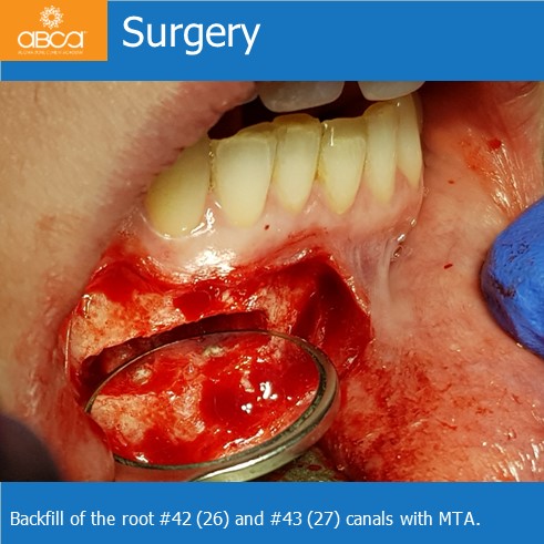 Osteoid Osteoma in the Front of the Mandible