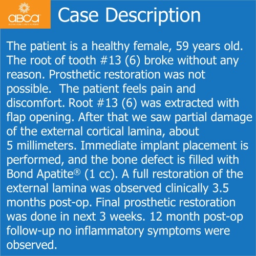 Fracture of Root #13 (6) Immediate Implant Placement with Bond Apatite