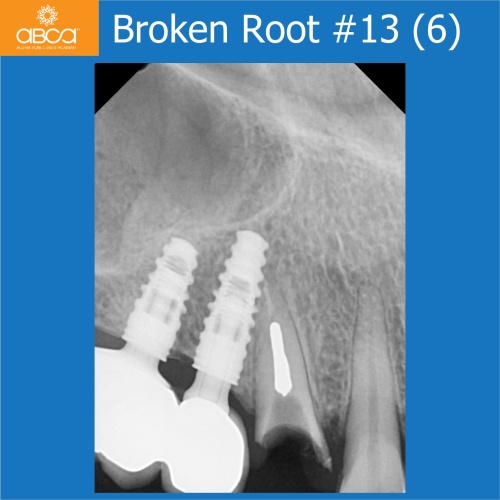 Fracture of Root #13 (6) Immediate Implant Placement with Bond Apatite