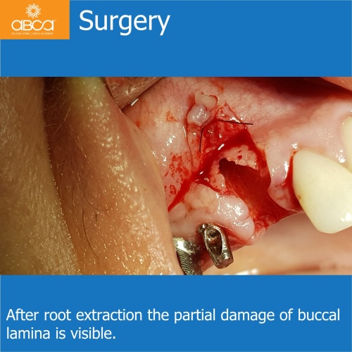 Fracture of Root #13 (6) Immediate Implant Placement with Bond Apatite