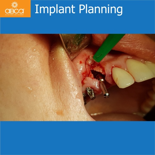 Fracture of Root #13 (6) Immediate Implant Placement with Bond Apatite