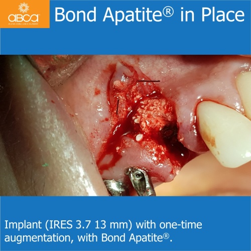 Fracture of Root #13 (6) Immediate Implant Placement with Bond Apatite