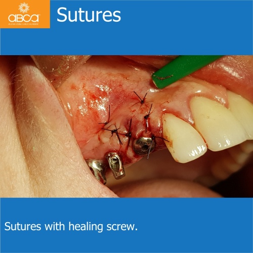 Fracture of Root #13 (6) Immediate Implant Placement with Bond Apatite
