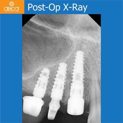 Fracture of Root #13 (6) Immediate Implant Placement with Bond Apatite