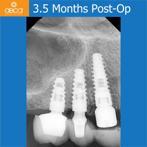 Fracture of Root #13 (6) Immediate Implant Placement with Bond Apatite