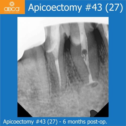 Fracture of Root #13 (6) Immediate Implant Placement with Bond Apatite