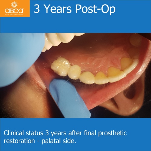 Fracture of Root #13 (6) Immediate Implant Placement with Bond Apatite
