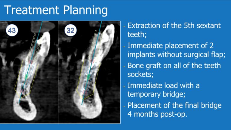 Immediate Rehabilitation of the Fifth Sextant with Immediate Load