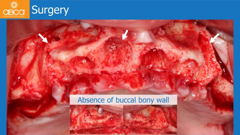 Full Arch Rehabilitation of the Maxilla with an Immediate All-on-4