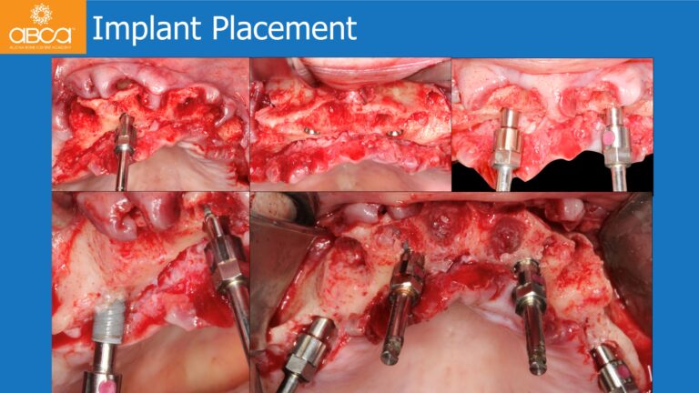 Full Arch Rehabilitation of the Maxilla with an Immediate All-on-4