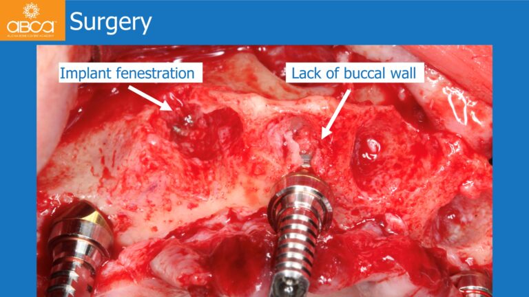 Full Arch Rehabilitation of the Maxilla with an Immediate All-on-4