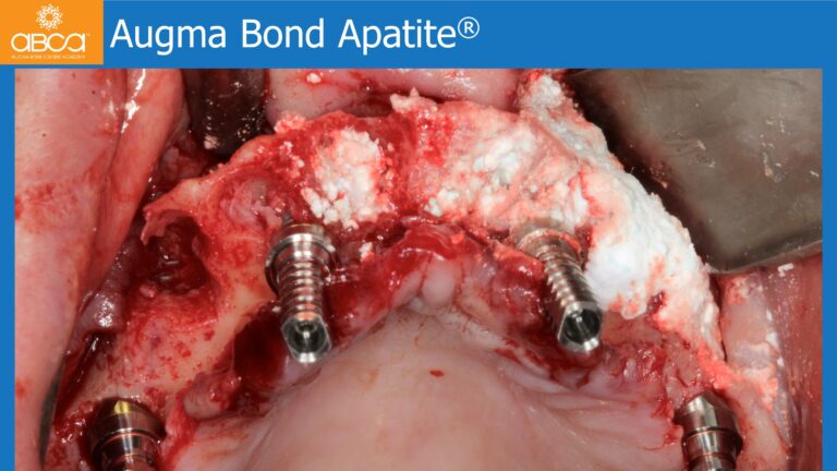 Full Arch Rehabilitation of the Maxilla with an Immediate All-on-4