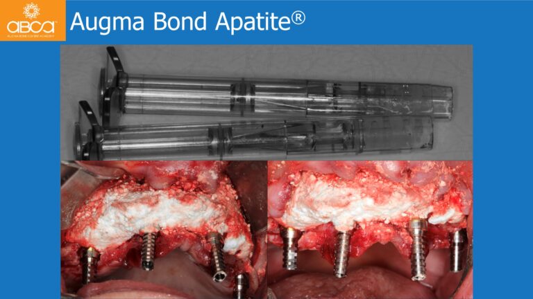 Full Arch Rehabilitation of the Maxilla with an Immediate All-on-4