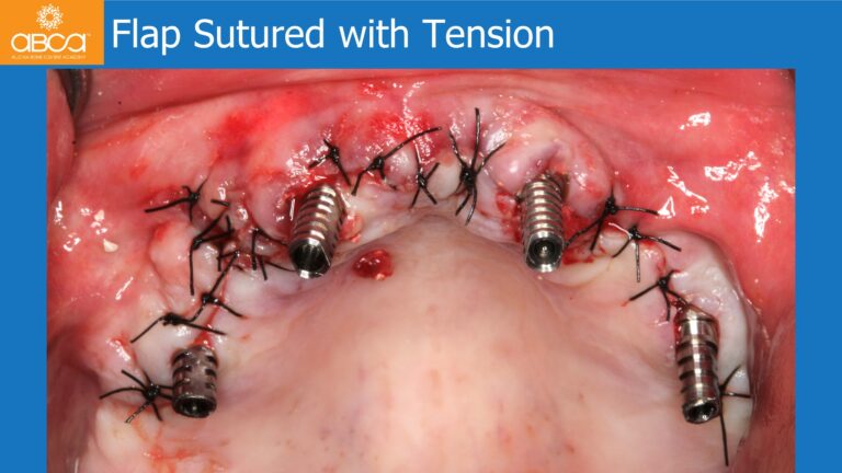 Full Arch Rehabilitation of the Maxilla with an Immediate All-on-4