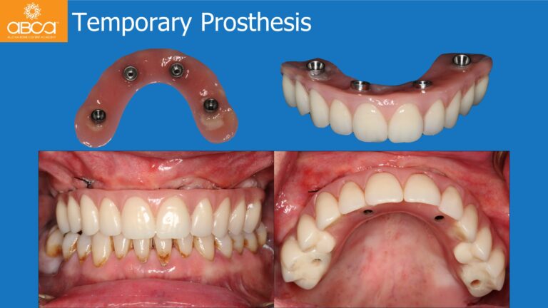 Full Arch Rehabilitation of the Maxilla with an Immediate All-on-4