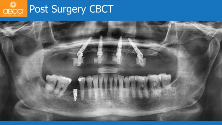 Full Arch Rehabilitation of the Maxilla with an Immediate All-on-4
