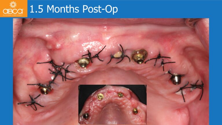 Full Arch Rehabilitation of the Maxilla with an Immediate All-on-4
