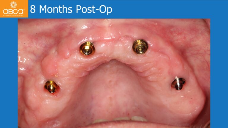Full Arch Rehabilitation of the Maxilla with an Immediate All-on-4