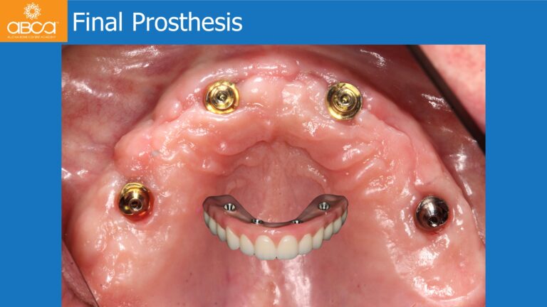 Full Arch Rehabilitation of the Maxilla with an Immediate All-on-4