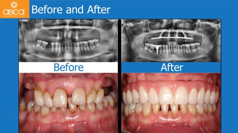 Full Arch Rehabilitation of the Maxilla with an Immediate All-on-4