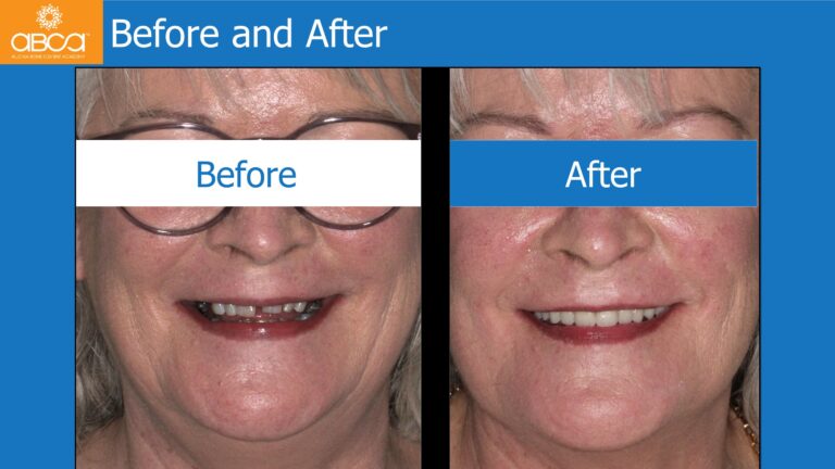 Full Arch Rehabilitation of the Maxilla with an Immediate All-on-4