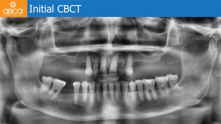 Full Arch Rehabilitation of the Maxilla with an Immediate All-on-4