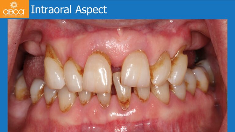 Full Arch Rehabilitation of the Maxilla with an Immediate All-on-4