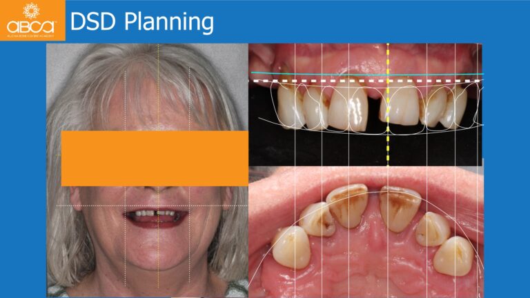 Full Arch Rehabilitation of the Maxilla with an Immediate All-on-4