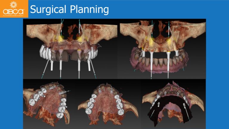 Full Arch Rehabilitation of the Maxilla with an Immediate All-on-4