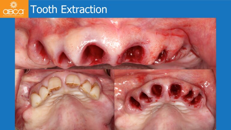 Full Arch Rehabilitation of the Maxilla with an Immediate All-on-4