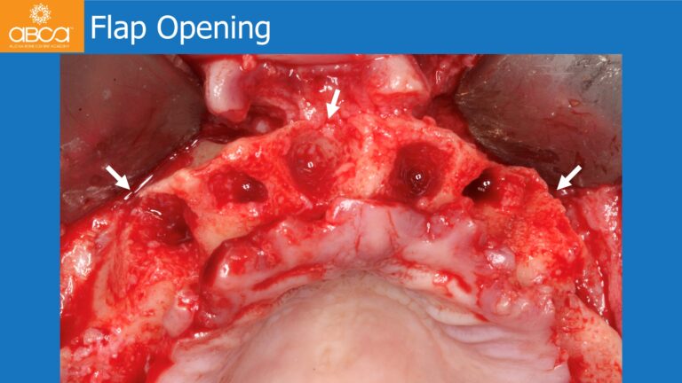 Full Arch Rehabilitation of the Maxilla with an Immediate All-on-4