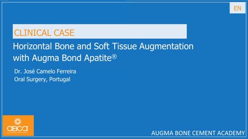 Horizontal Bone and Soft Tissue Augmentation with Augma Bond Apatite