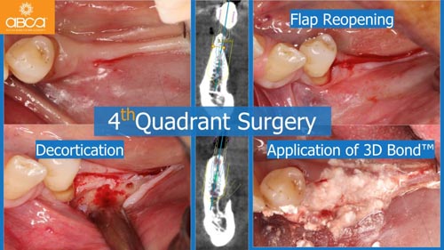 Horizontal Bone and Soft Tissue Augmentation with Augma Bond Apatite