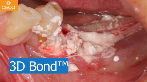 Horizontal Bone and Soft Tissue Augmentation with Augma Bond Apatite