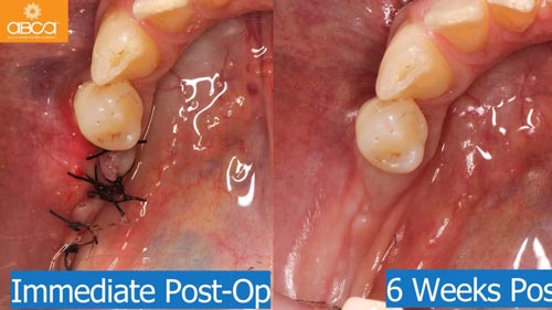 Horizontal Bone and Soft Tissue Augmentation with Augma Bond Apatite