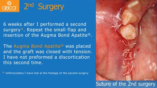 Horizontal Bone and Soft Tissue Augmentation with Augma Bond Apatite