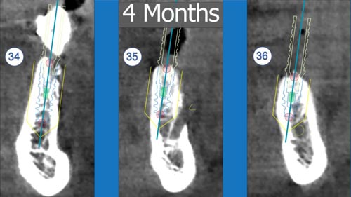 Horizontal Bone and Soft Tissue Augmentation with Augma Bond Apatite