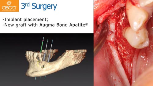 Horizontal Bone and Soft Tissue Augmentation with Augma Bond Apatite